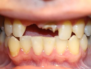 dental implants, Dental Implants in Reading