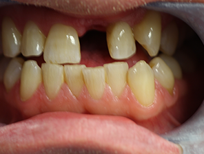 dental implants, Dental Implants in Reading