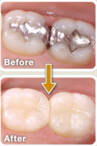 , Composite White Fillings in Reading